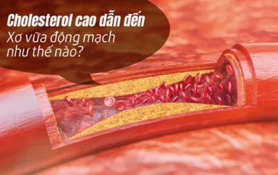 Mối liên hệ giữa xơ vữa động mạch và mỡ máu cao – Bạn có biết?
