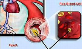 Mỡ máu cao gây hại gì cho hệ thống tim mạch?